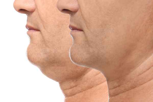 HIFU - Breakthrough in Anti - ageing 2 hifu results Scotland
