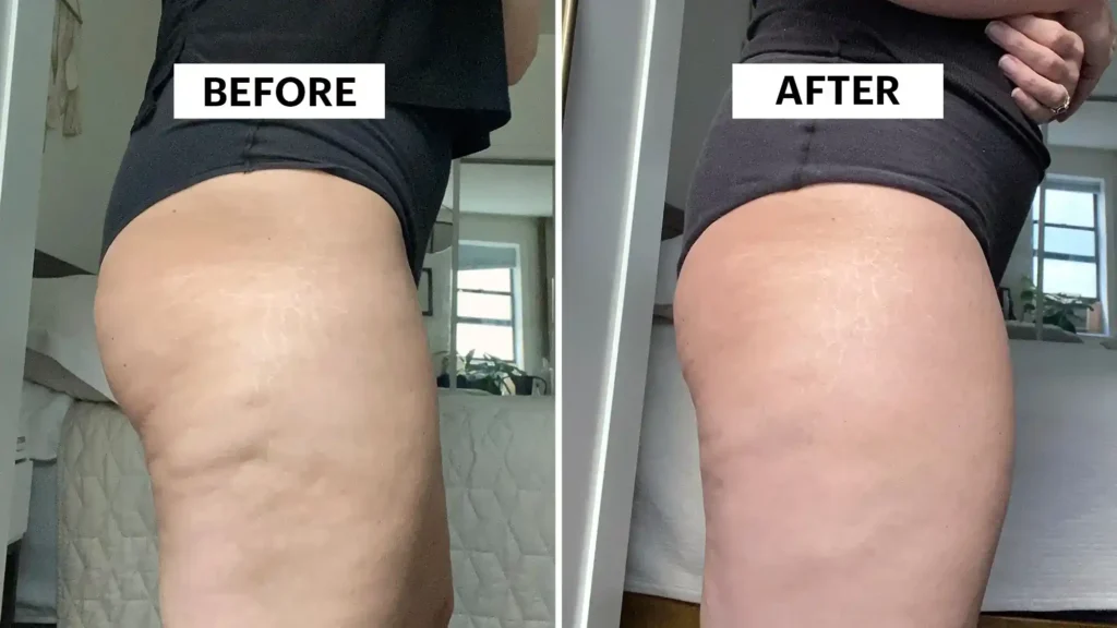 Sculpting Your Bum: Can Toning Exercises Really Reduce Cellulite? 1 Do Toning Exercise Scotland Really Tackle Cellulite?