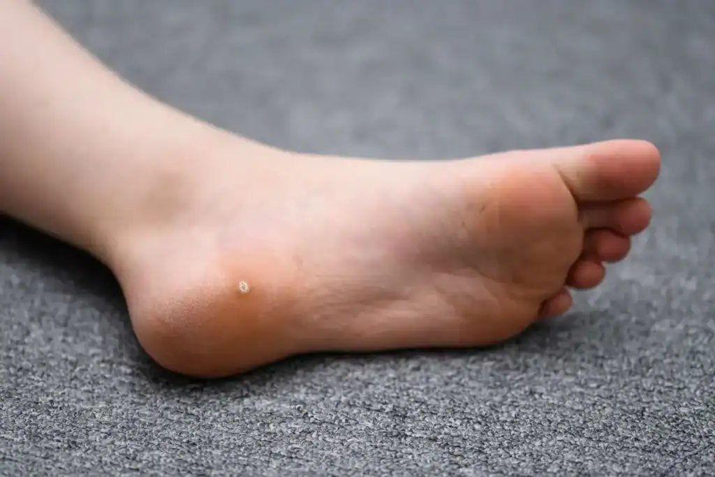 Cryotherapy For Warts And Also Verrucas 2 Image of verruca on the bottom of the foot that able to be treated with Cryotherapy Scotland