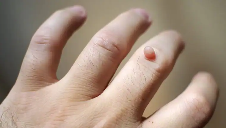 Cryotherapy For Warts And Also Verrucas 1 Image of blemish that Cryotherapy Scotland can remove with Lipo 360.