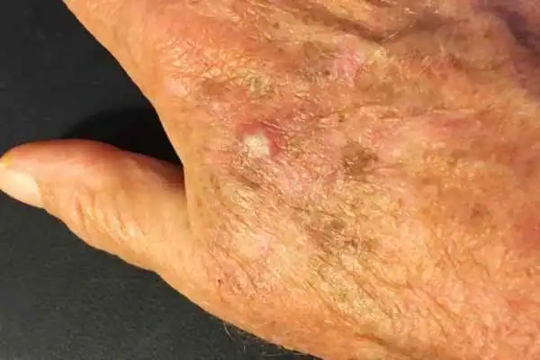 Cryopen For Actinic Keratoses 1 Image of Actinic keratoses Scotland on a person hand