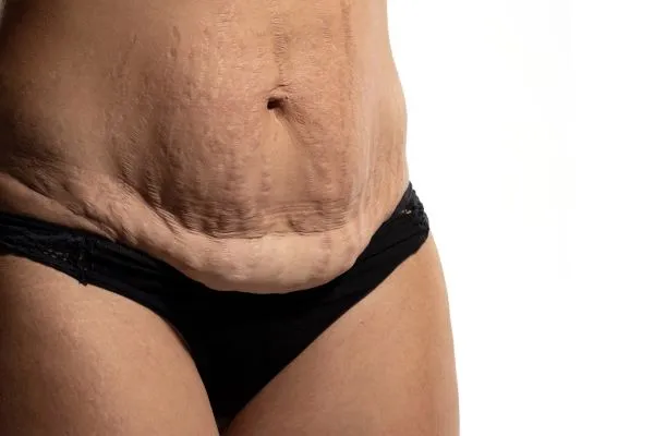 The science behind skin tightening Scotland picture of a woman's sagging skin on the stomach